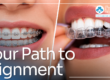 teeth with braces and teeth with clear aligners